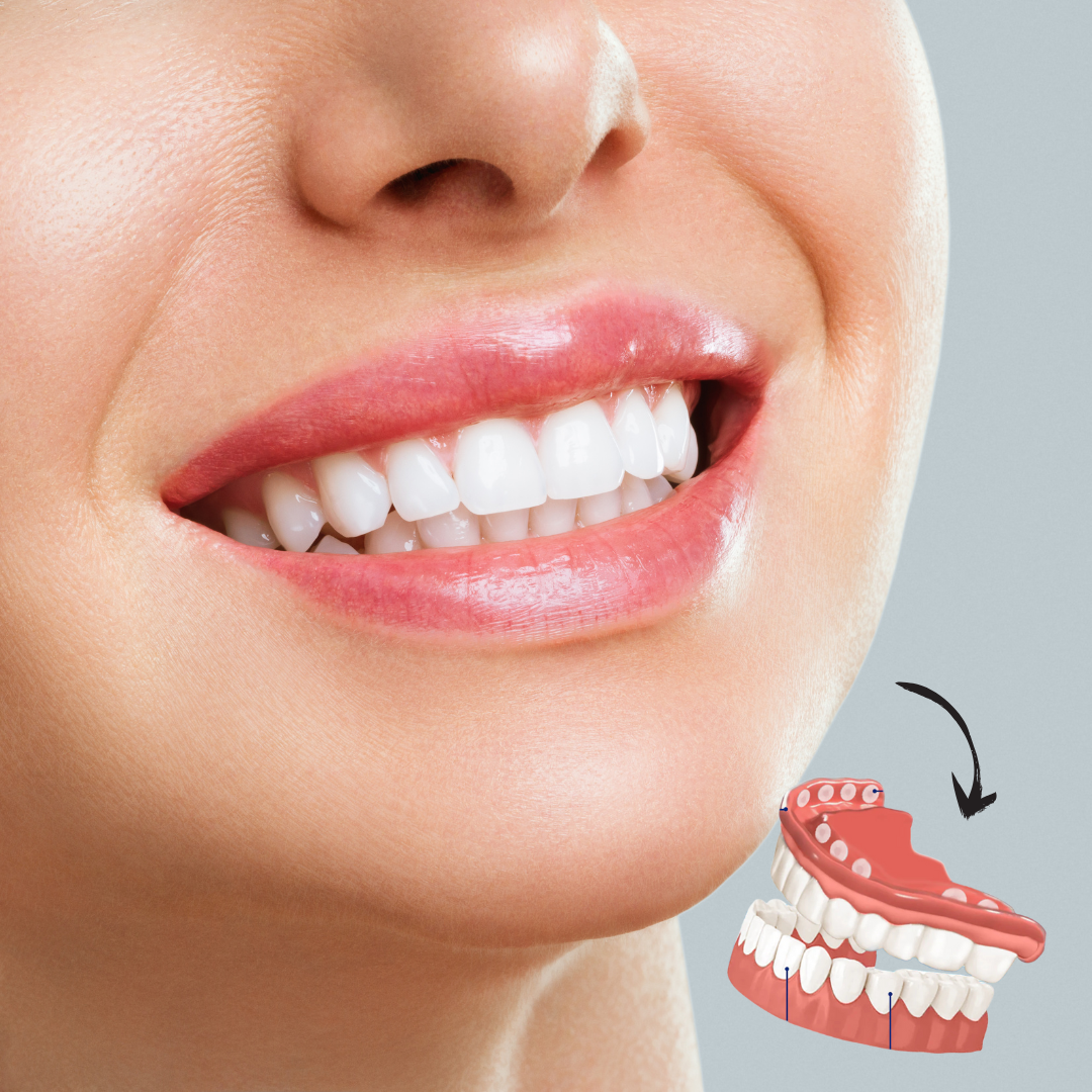 Removable Cosmetic Teeth Veneers for Adults – Instant Smile Enhancer with Silicone Liner, Reusable Snap-On Dental Cover for Natural Look | Thomler