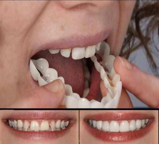 Removable Snap-On Veneers for Temporary Smile Makeover – Heat-Moldable Cosmetic Teeth Covers for Top Teeth | Thomler