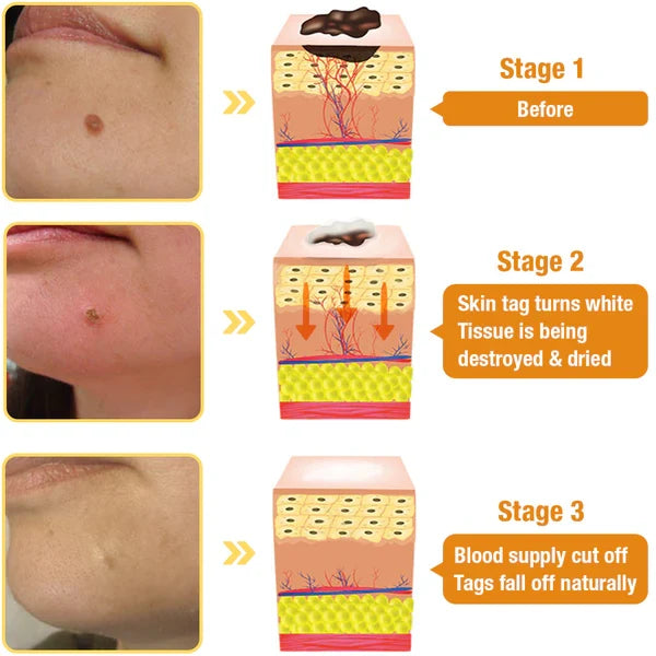 Skin Tag Removal Spray with Natural Bee Venom Extract for At-Home Treatment of Tags, Warts & Moles | Thomler