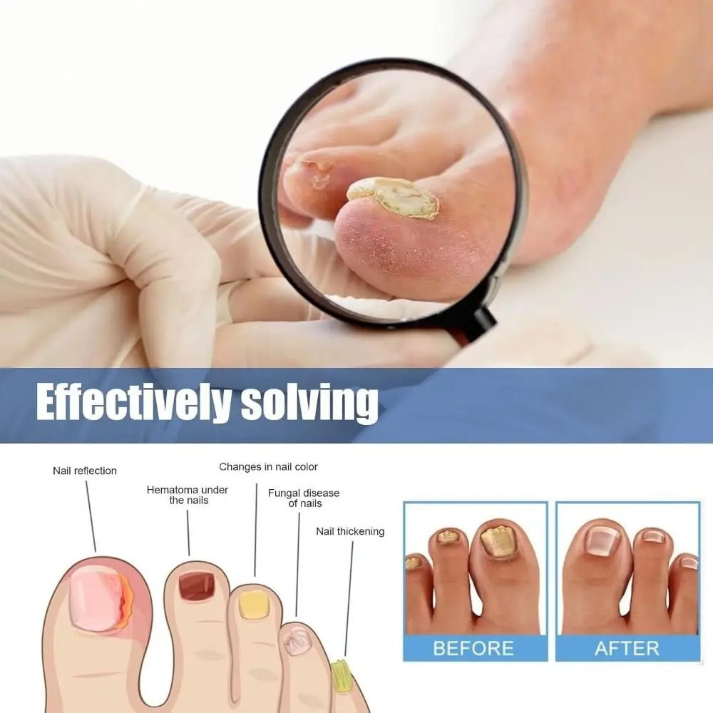 Toenail Repair Patches – Breathable Care for Discolored & Thickened Nails | Thomler