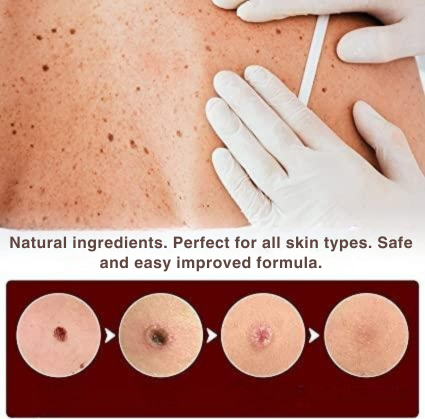 Skin Tag & Wart Removal Pen with Precision Applicator Tip for Spot Treatment at Home | Natural Plant-Based Formula | Thomler