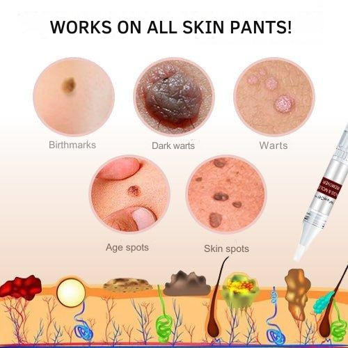 Skin Tag & Wart Removal Pen with Precision Applicator Tip for Spot Treatment at Home | Natural Plant-Based Formula | Thomler