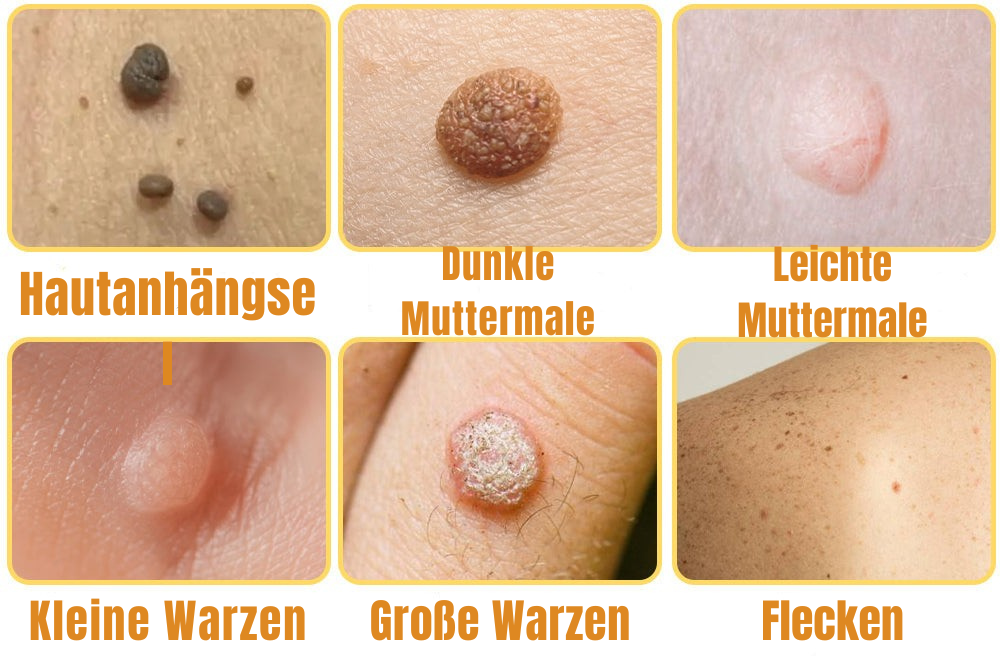Skin Tag Removal Spray for Warts & Blemishes - Bee Venom Formula - Pain-Free Application - For All Skin Types - Face, Neck, Body Treatment - | Thomler