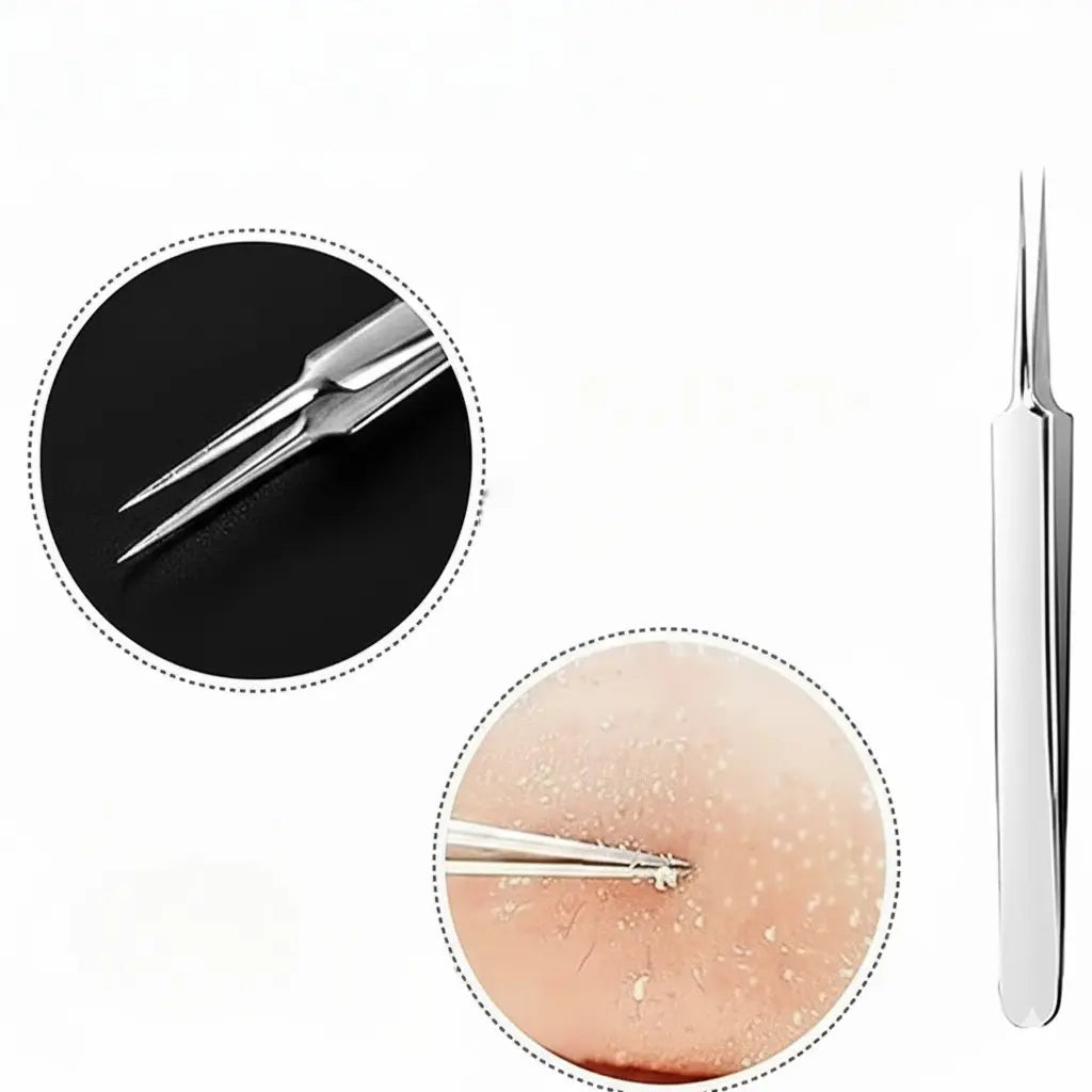 Stainless Steel Pore Extractor Tools for Acne, Clogged Pores, and Blemish Care at Home – Professional Skincare Set | Thomler