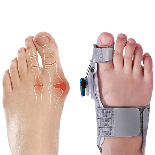 Adjustable Toe Straightener with Hinge System for Hallux Valgus Relief & Foot Alignment – Silicone Spacer for Day & Night Support | Thomler