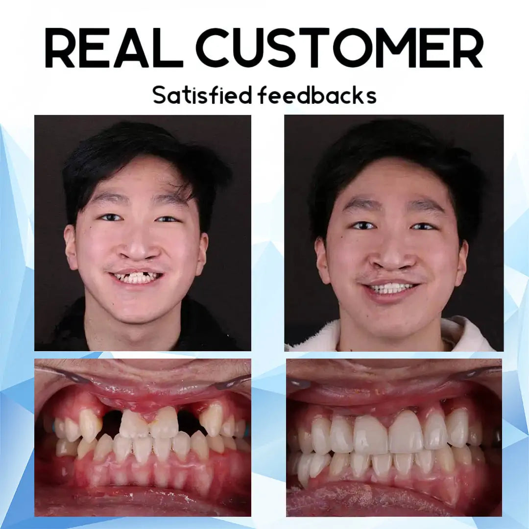 Removable Cosmetic Teeth Veneers for Adults – Instant Smile Enhancer with Silicone Liner, Reusable Snap-On Dental Cover for Natural Look | Thomler