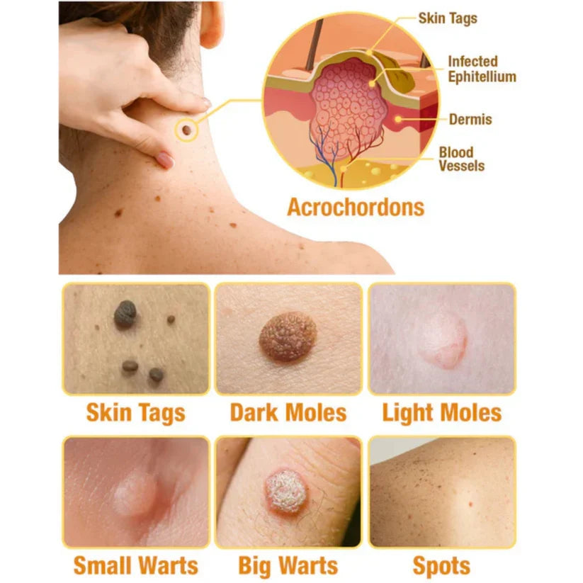 Skin Tag Removal Spray with Natural Bee Venom Extract for At-Home Treatment of Tags, Warts & Moles | Thomler