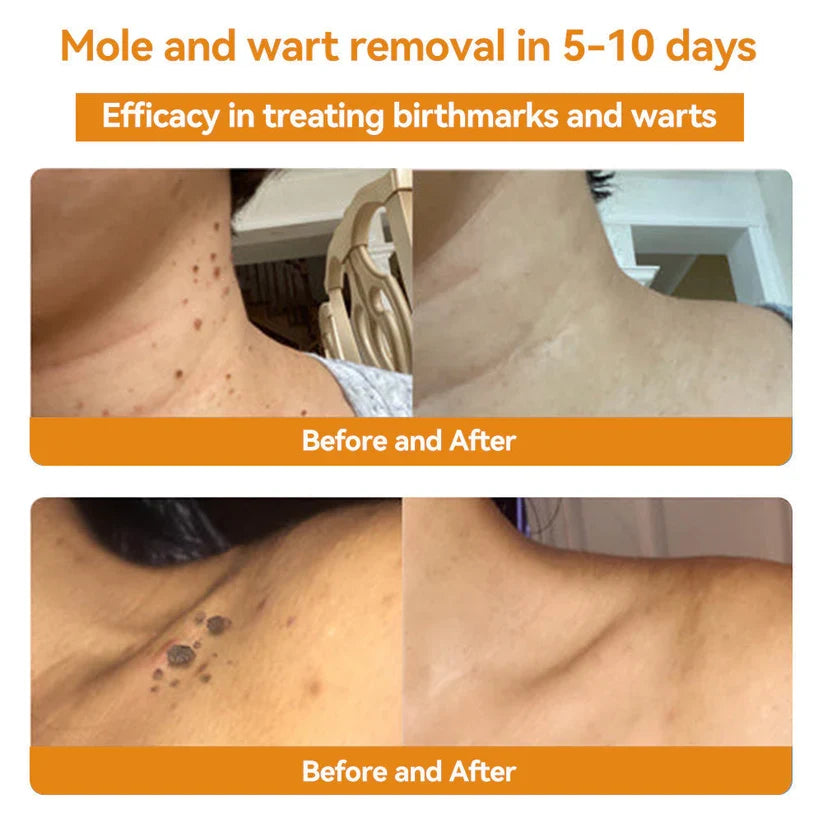 Skin Tag & Wart Removal Spray with Natural Bee Venom Extract for Blemish-Free Complexion at Home Treatment | Thomler