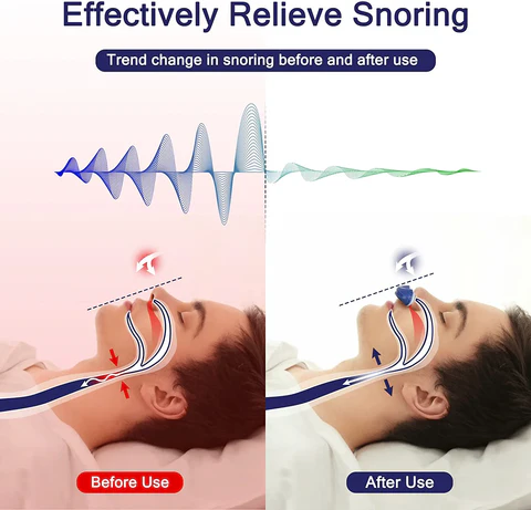 Portable Sleep Apnea Relief Device Anti-Snoring Nasal Airway Support System for Travel Home Bedroom USB Rechargeable Silicone Soft Ear Clips | Thomler