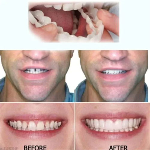 Cosmetic Tooth Veneer Snap-On Cover – Adjustable Fit for Natural-Looking Smile, Removable & Reusable Temporary Smile Enhancement | Thomler
