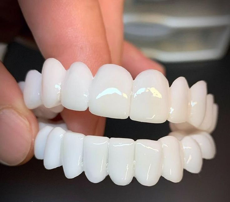 Snap-On Cosmetic Teeth Veneers for Covering Gaps, Stains & Missing Teeth – Reusable Smile Enhancement for Daily Confidence & Special Events | Thomler