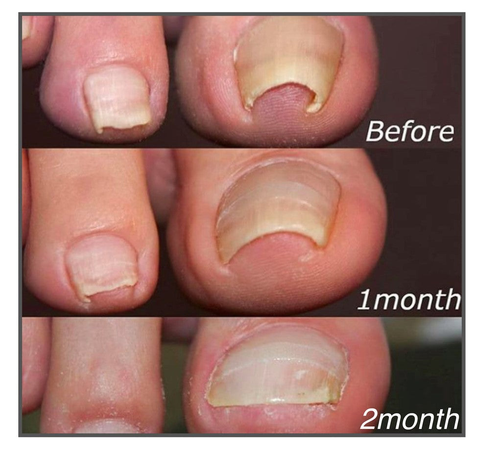 Toenail Alignment Strips for Smooth Appearance | Self-Adhesive Nail Care Patches | Easy Application for Groomed Toenails at Home | Thomler