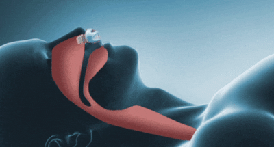 Cordless Anti-Snore Breathing Device – Compact Sleep Aid with Nasal Inserts for Nighttime Airway Support | Thomler