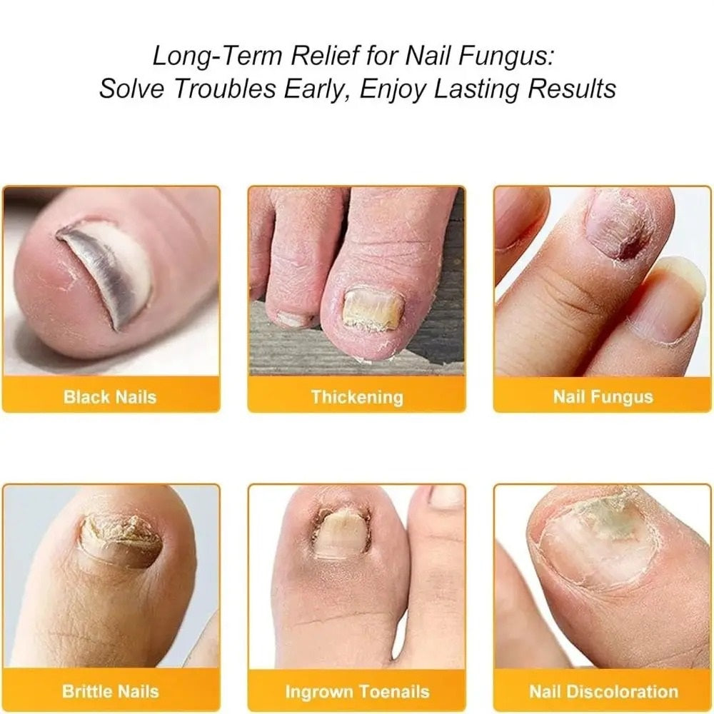 Toenail Repair Patches – Breathable Care for Discolored & Thickened Nails | Thomler
