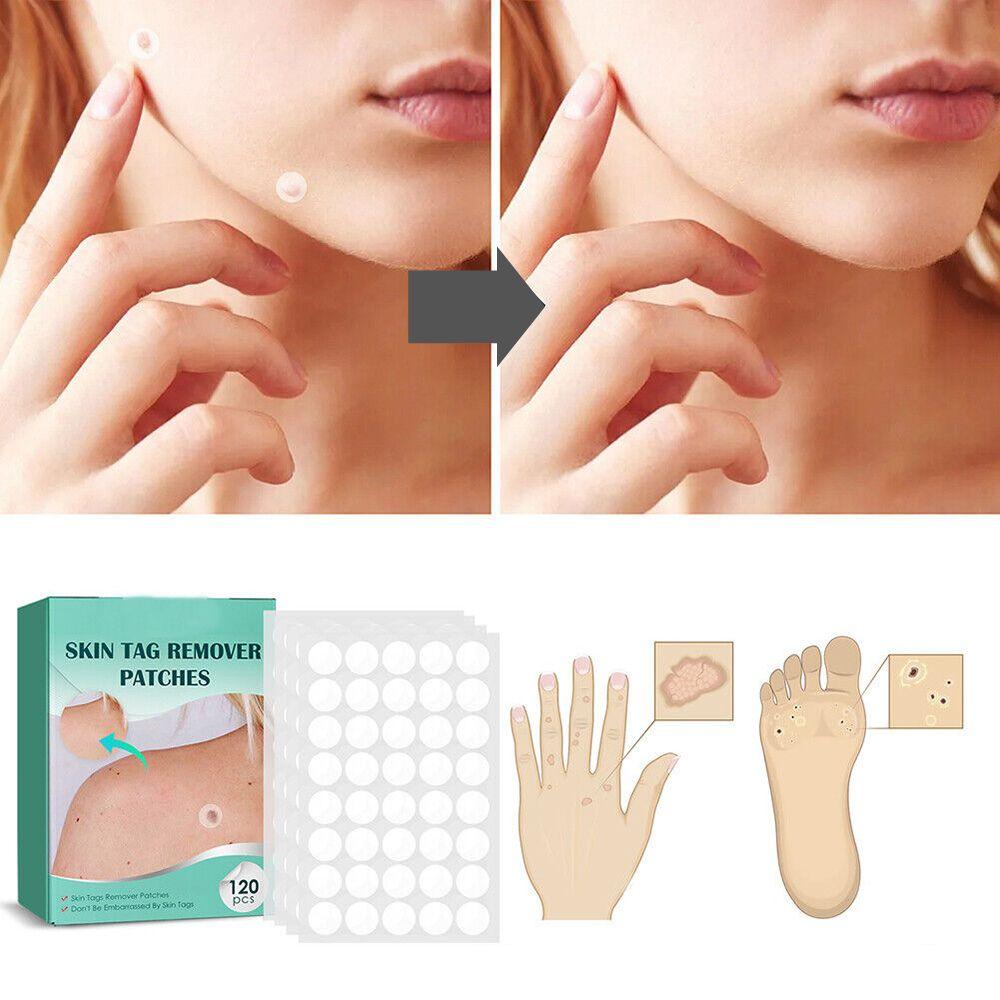 Hydrocolloid Skin Tag & Wart Remover Patches 120-Pack | Gentle Spot Treatment for Home Use | Invisible Adhesive Discs with Tea Tree Oil for | Thomler
