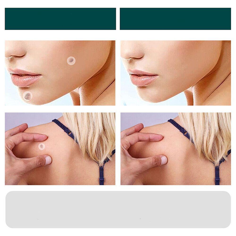 Hydrocolloid Skin Tag & Wart Remover Patches 120-Pack | Gentle Spot Treatment for Home Use | Invisible Adhesive Discs with Tea Tree Oil for | Thomler