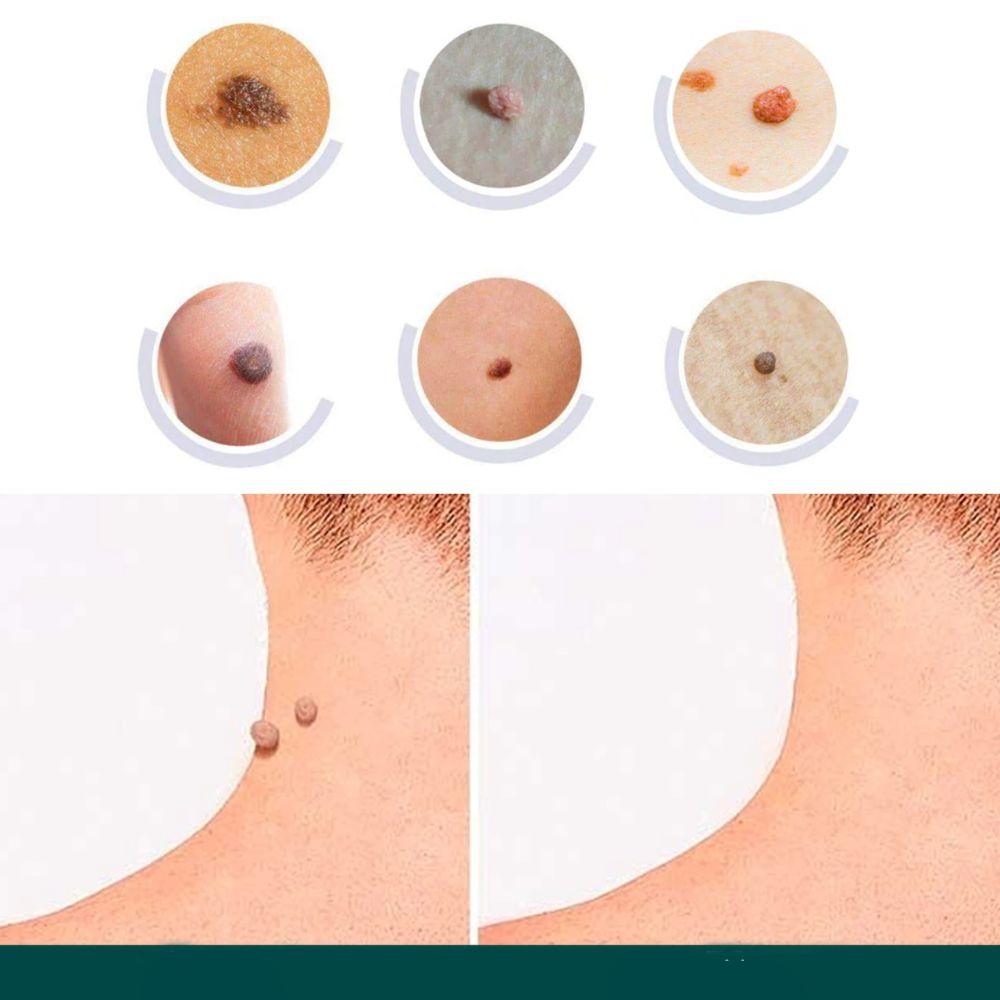 Hydrocolloid Skin Tag & Wart Remover Patches 120-Pack | Gentle Spot Treatment for Home Use | Invisible Adhesive Discs with Tea Tree Oil for | Thomler