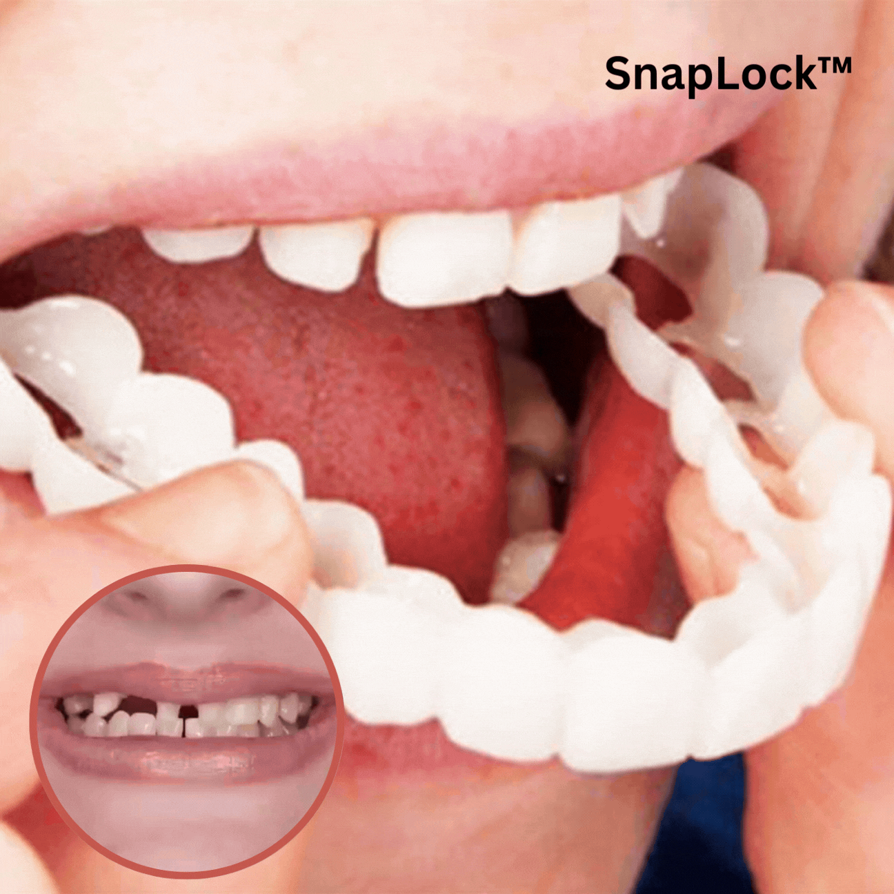 Moldable Snap-On Veneers for Upper & Lower Teeth – Custom-Fit Cosmetic Cover for a Natural White Smile | Thomler