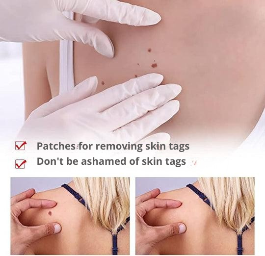Skin Tag & Wart Removal Pen with Precision Applicator Tip for Spot Treatment at Home | Natural Plant-Based Formula | Thomler