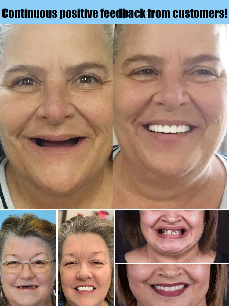 Moldable Cosmetic Denture Set Upper & Lower – Heat-Fit Natural White Teeth for Everyday Confidence | Thomler