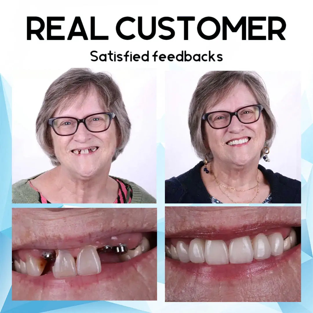 Removable Cosmetic Teeth Veneers for Adults – Instant Smile Enhancer with Silicone Liner, Reusable Snap-On Dental Cover for Natural Look | Thomler