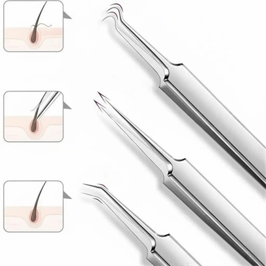 Stainless Steel Pore Extractor Tools for Acne, Clogged Pores, and Blemish Care at Home – Professional Skincare Set | Thomler