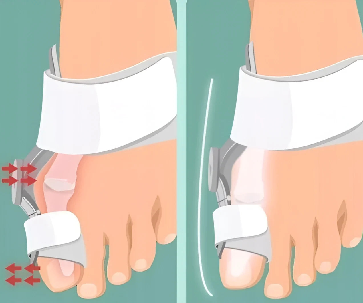 Adjustable Big Toe Splint for Bunion Relief & Alignment | Hinged Night Brace for Pain-Free Walking & Sleep Recovery | Thomler