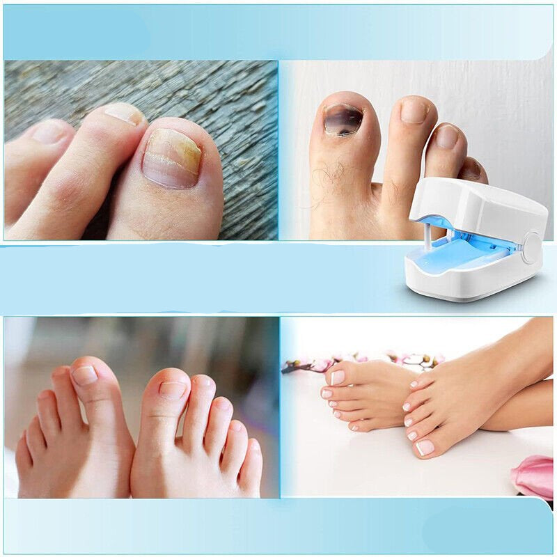 Portable Laser Treatment Pen for Toenail Fungus – 7-Minute Light Therapy Device for Nail Health & Clarity at Home | Thomler