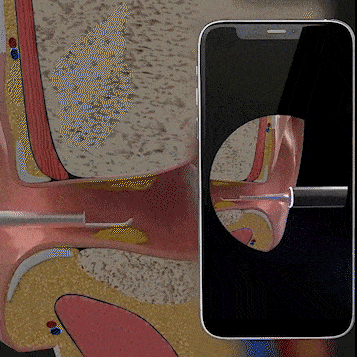 Visual Ear Wax Removal Tool with HD Camera Scope for iPhone Android Wireless Ear Cleaning Kit Safe Scoop Adults Kids | Thomler