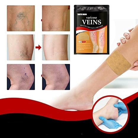 Circulation Support Patches for Legs Spider Vein Relief Swelling Reduction Botanical Formula Discreet Wear Under Clothing Post-Workout | Thomler